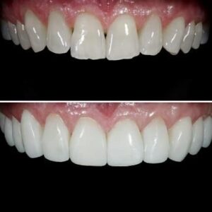 Affordable-composite-veneers-at-Pro-Dental-Nairobi-clinic-offering-budget-friendly-smile-makeovers
