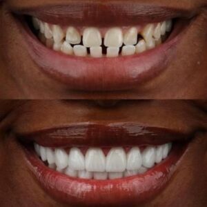 Porcelain-veneers-by-Gordon-Family-Dentistry-in-Nairobi-offering-premium-cosmetic-dental-solutions